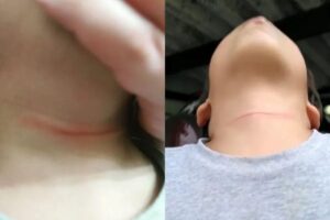 A mãe viu marcas no pescoço da criança quando voltou da escola