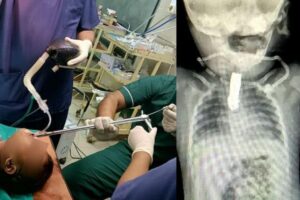 O bebê de 8 meses passou por cirurgia após engolir cortador de unha