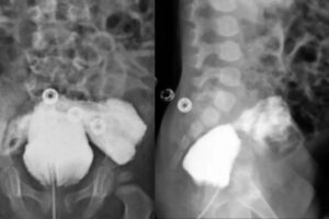 Menino nasceu sem pênis, no Irã