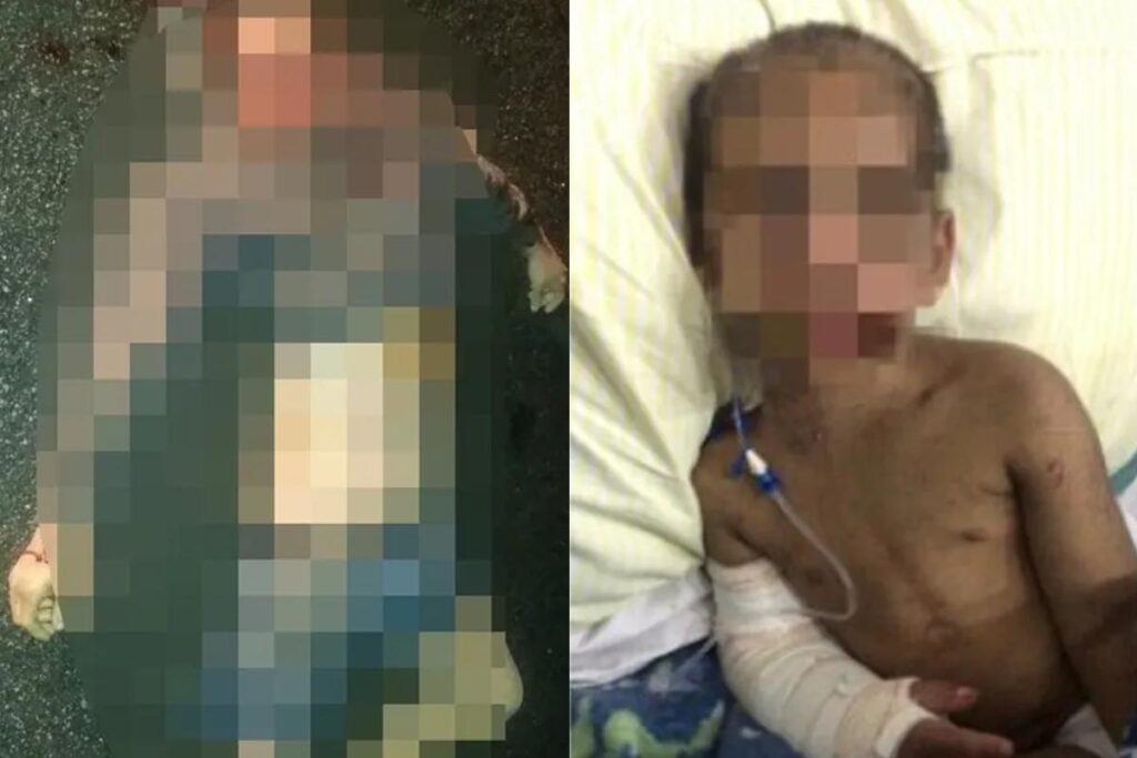 Menino de 5 anos tem oito costelas e braço fraturados pela mãe e padrasto em São Vicente/SP