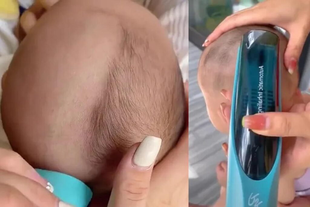 Cabelo do bebê foi raspado com aparelho