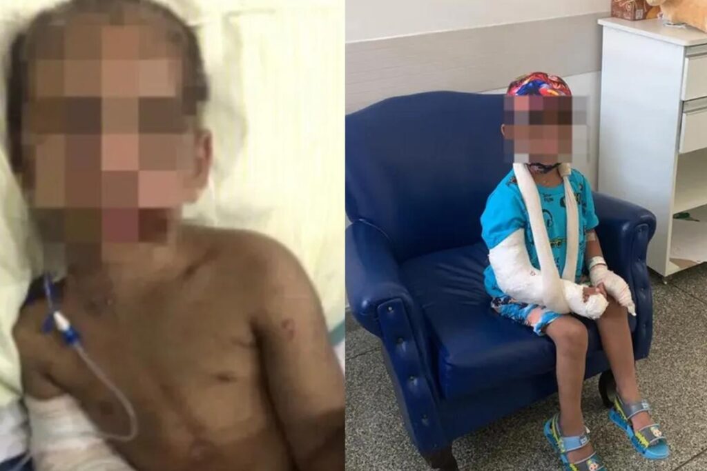 A vítima teve 8 costelas e braço fraturados pela mãe e pelo padrasto em São Vicente/SP