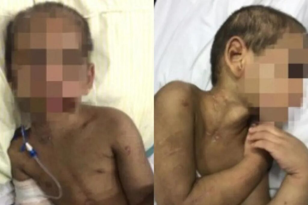 Estado da criança após violência causada pela mãe e pelo padrasto