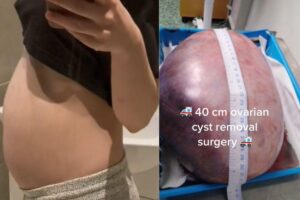 O cisto da mulher a surpreendeu