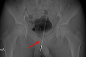 Menino de 12 anos insere termômetro no pênis e passa por cirurgia de emergência