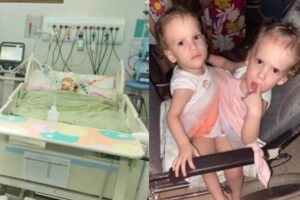 Em Goiás, gêmeas siamesas são separadas após procedimento de 17 horas