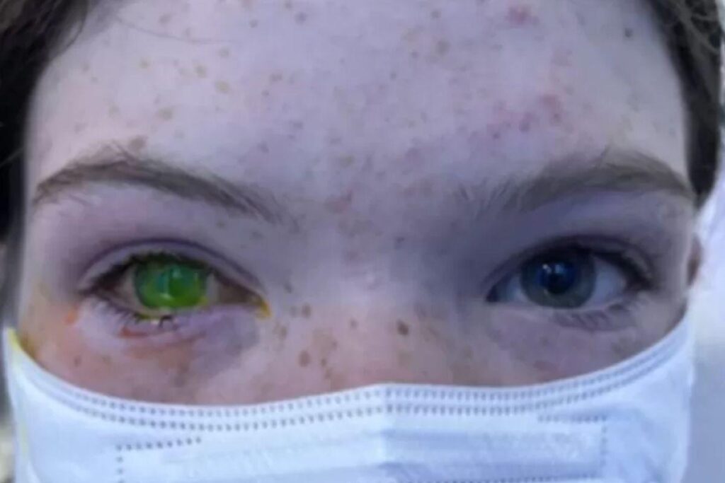 Já são ao menos, 30 casos na Austrália, desde dezembro