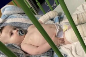 Ele sofreu graves queimaduras