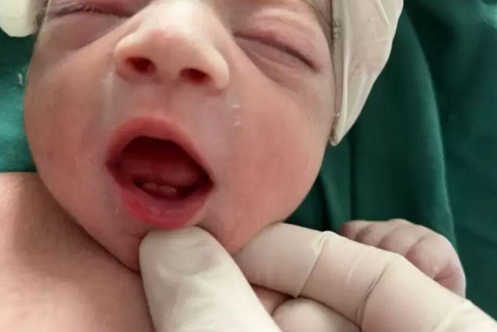Bebê nasce com dois dentes