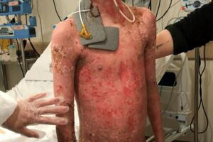 A pele dele foi caindo