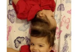 Médicos trabalham na cirurgia das gêmeas que nasceram unidas pela cabeça