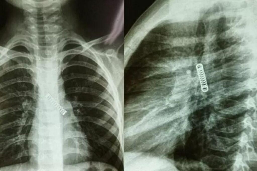 Menino engole mola e tem crise de tosse