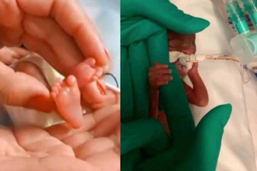 Emanuelly é a menor bebê já registrada em hospital público no Brasil