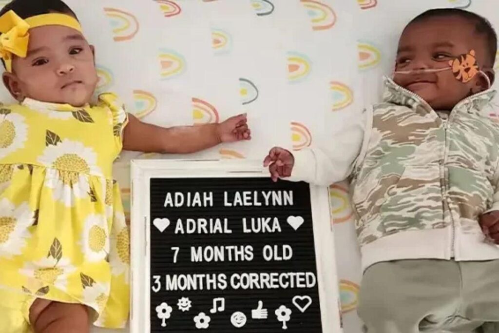 Gêmeos mais prematuros do mundo completando 1 ano