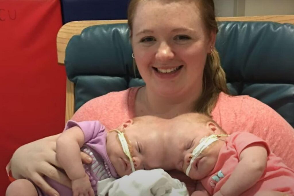 Os pais foram avisados que a chance de sobrevivência para as meninas era de 2%