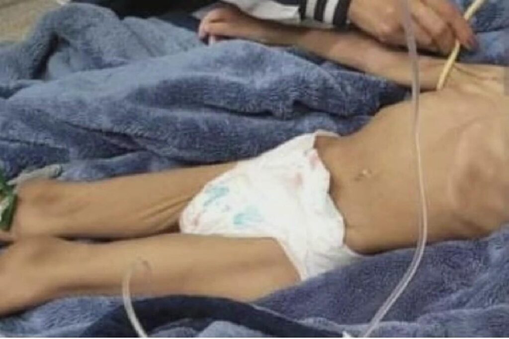 Menina com desnutrição foi encontrada pelas autoridades