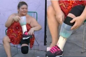 Mulher usa liquidificador como prótese após amputar a perna
