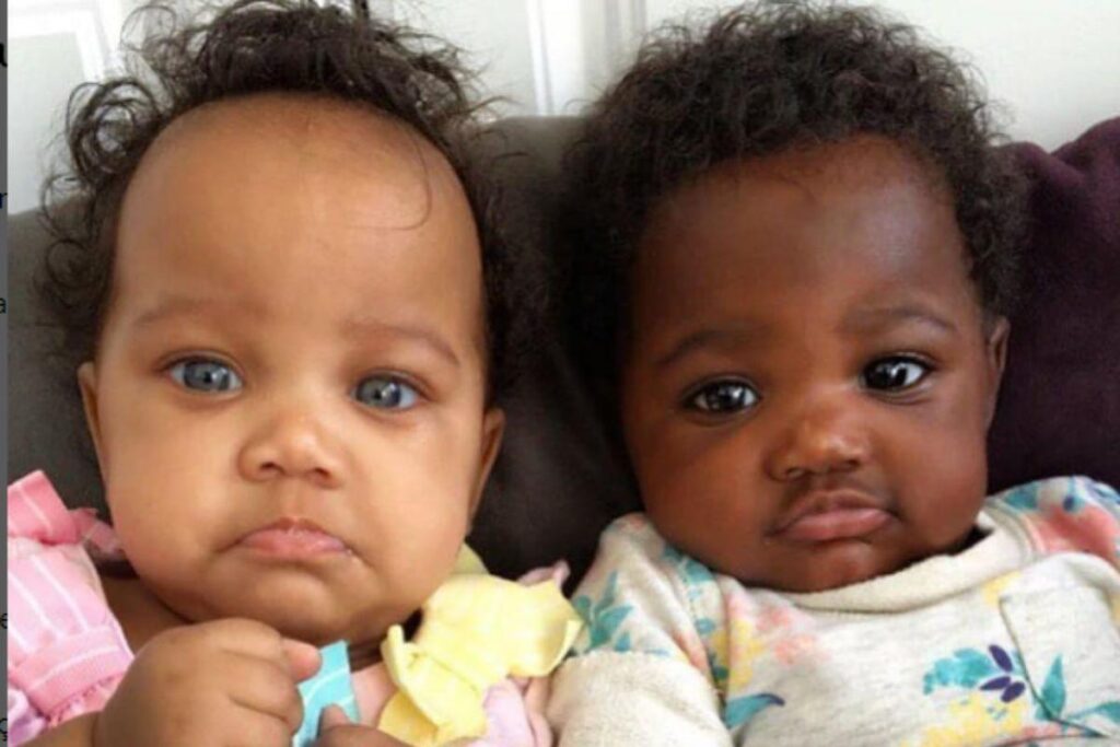 Gêmeas nascem com tonalidades de pele diferente