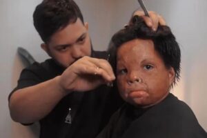 Menino que teve rosto queimado coloca coloca prótese capilar