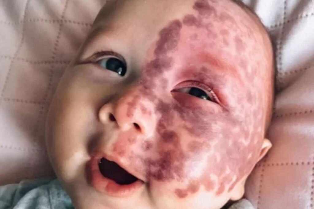 Bebê de 5 meses passa por tratamento com laser