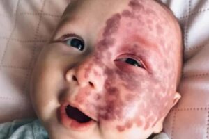 Bebê de 5 meses passa por tratamento com laser