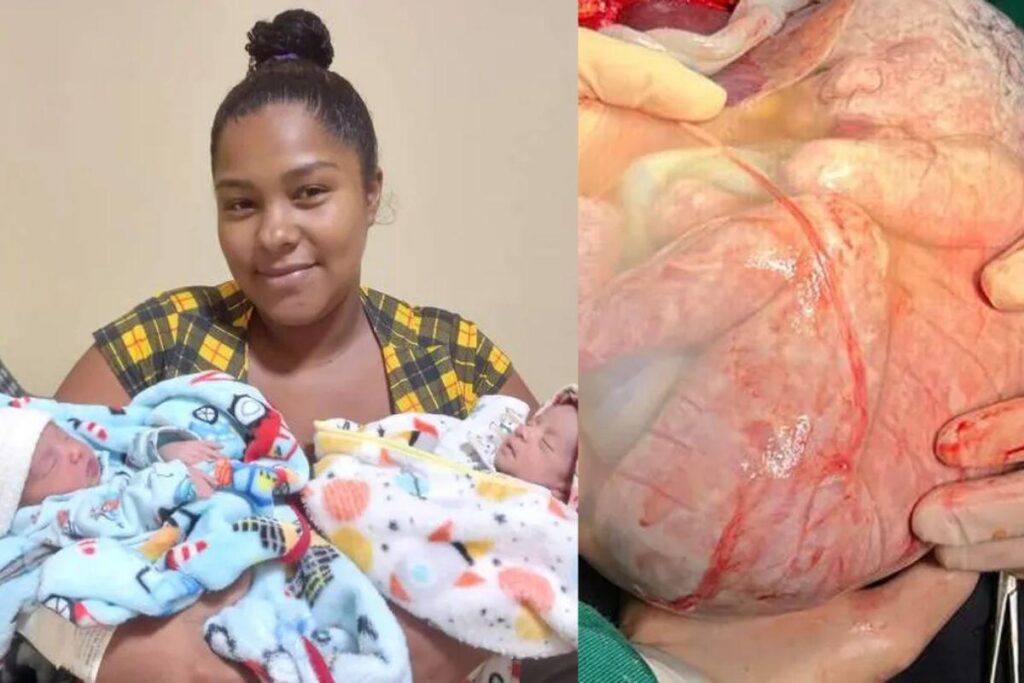 Um dos gêmeos nasceu empelicado