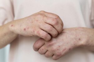 Os casos de sífilis tiveram aumento no Brasil em todas as faixas etárias e sexos