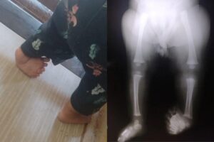 A menina tem 8 dedos no pé esquerdo