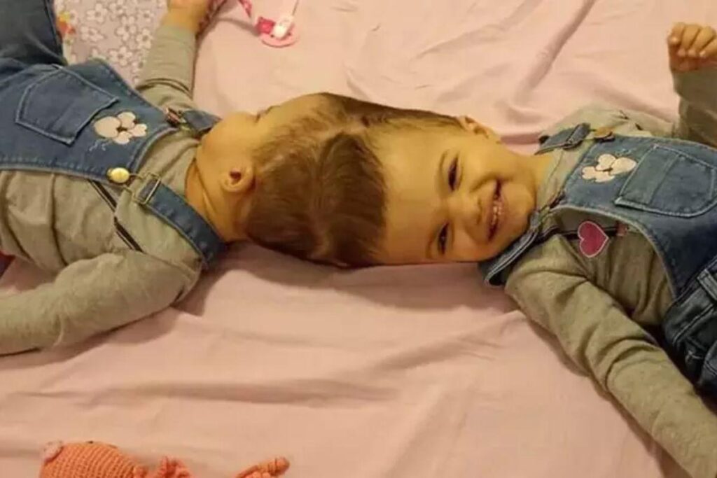 Gêmeas siamesas são separadas