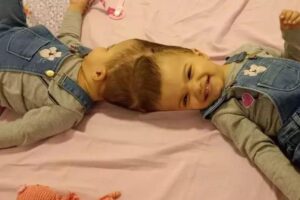 Gêmeas siamesas são separadas