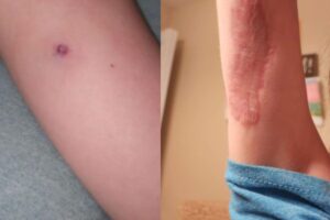 O que no início parecia ser um incômodo da etiqueta do pijama, foi crescendo