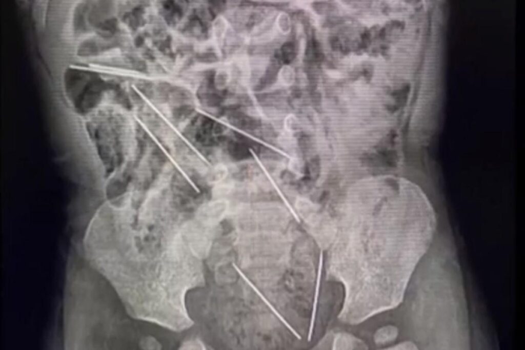 Os exames mostraram onde estavam as agulhas que o menino engoliu