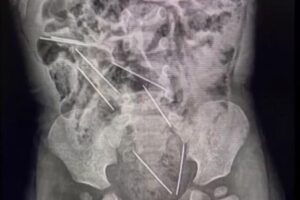 Os exames mostraram onde estavam as agulhas que o menino engoliu