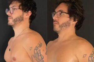 O ex-BBB ainda contou o motivo das cirurgias