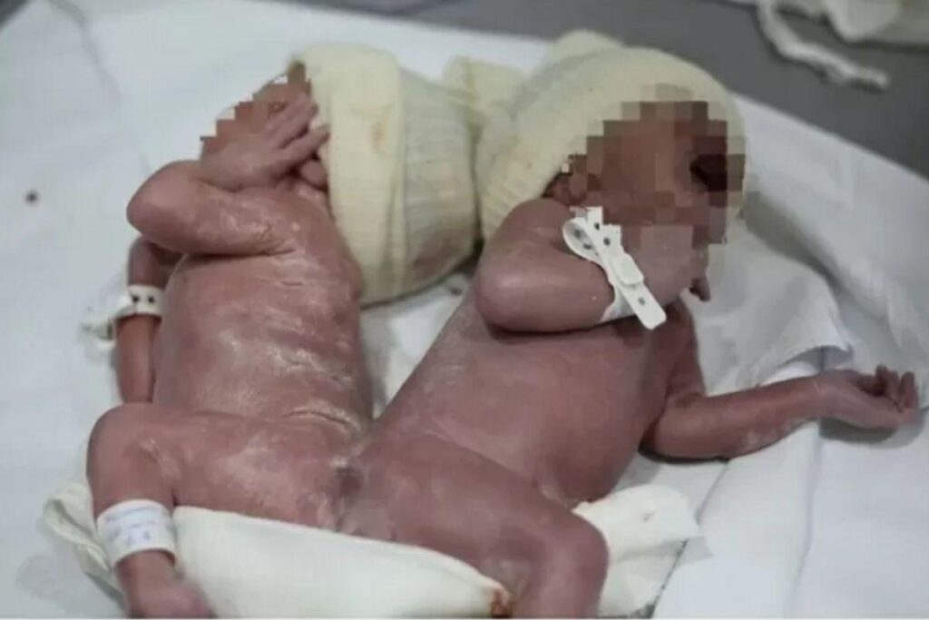 Gêmeos siameses nascem em Curitiba