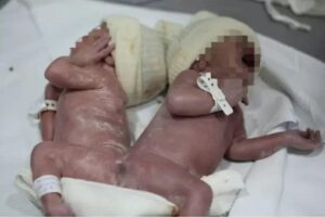 Gêmeos siameses nascem em Curitiba