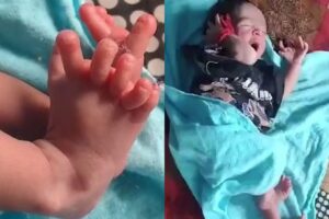 A bebê nasceu com 26 dedos