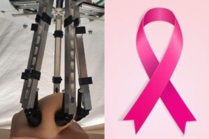 O câncer de mama é o segundo mais recorrente em pessoas no Brasil, segundo o Inca