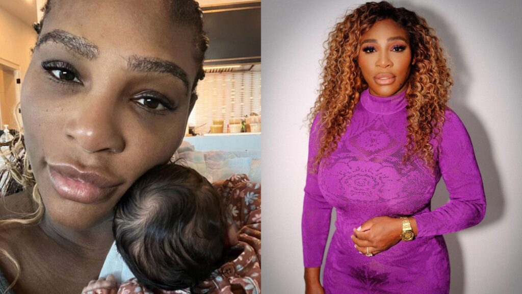 Serena Williams usa leite materno como remédio para queimadura