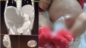 Em caso raro, bebê nasce com “rins supranumerários”