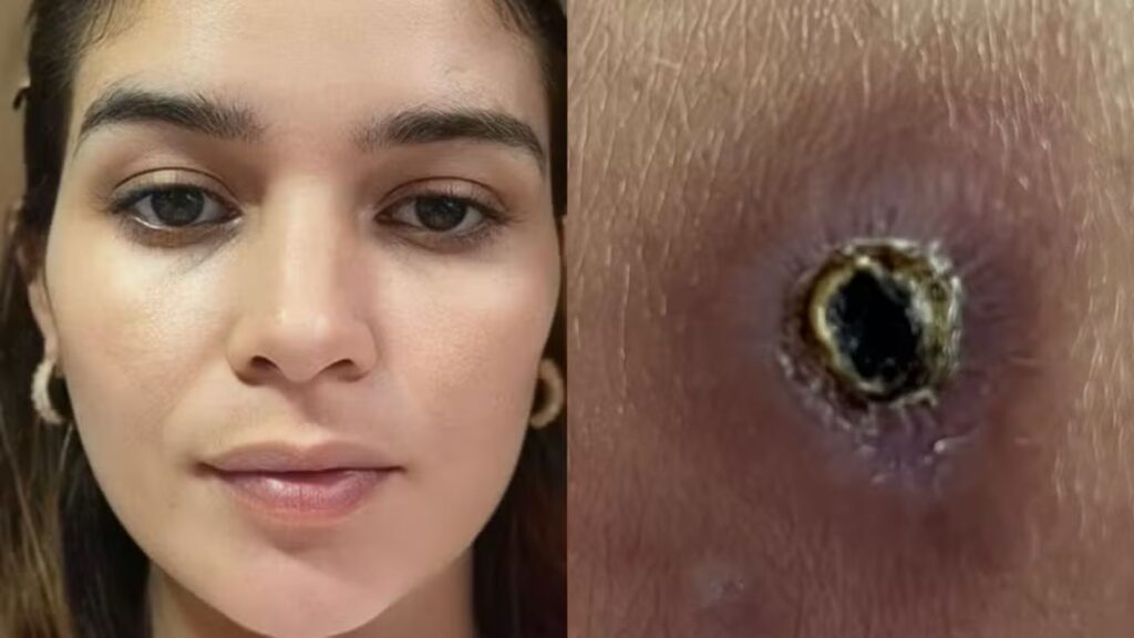 Perna de grávida fica necrosada após picada de aranha-marrom