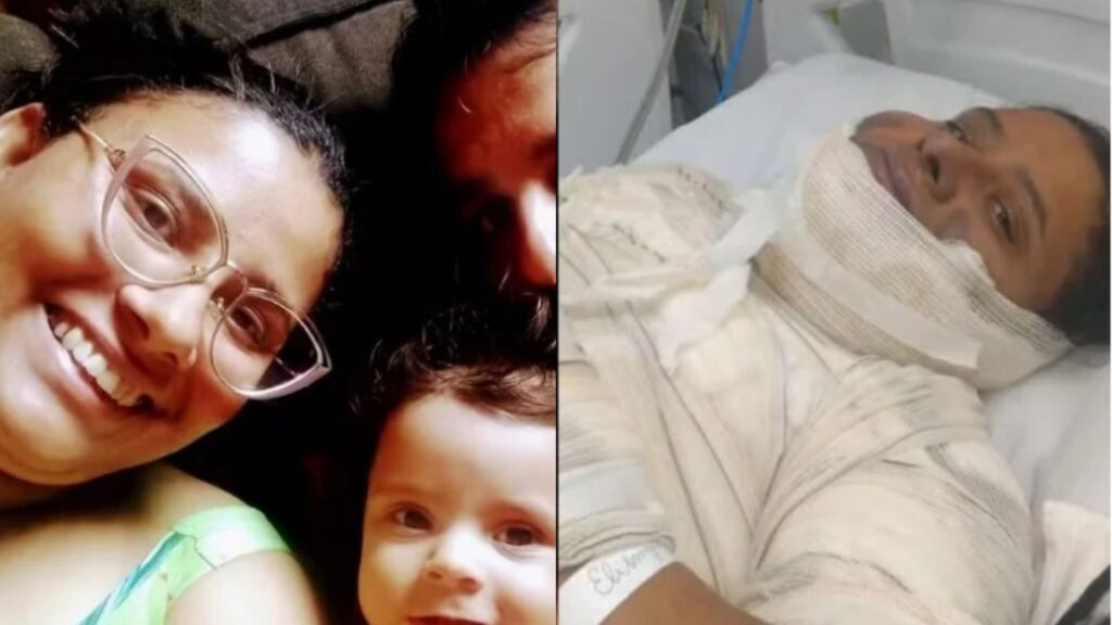 Mulher morre após sofrer queimaduras fritando ovo