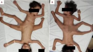 Gêmeos siameses nascem interligados pela pelve e com três pernas