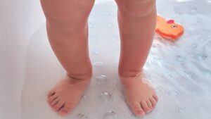 Os bebês são mais acometidos por brotoejas do que os adultos