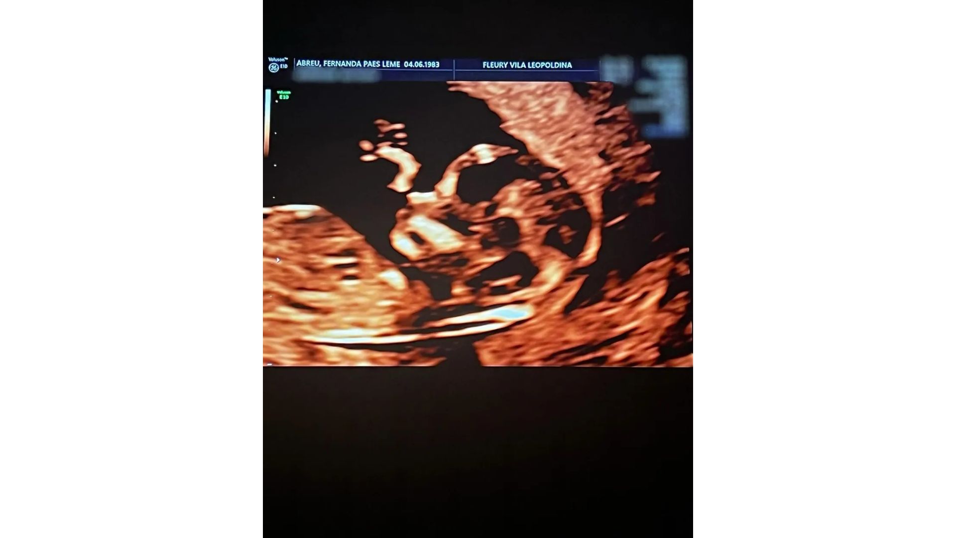 Fernanda Paes Leme ultrassom
