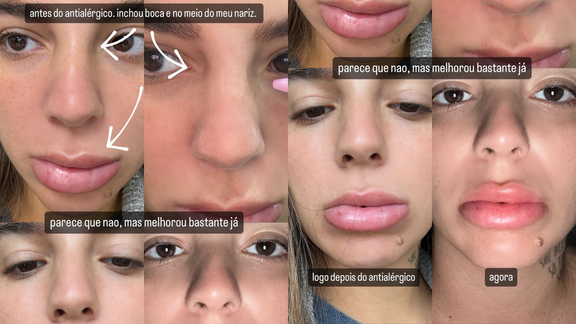 Stories de Petra Mattar sobre alergia e virose