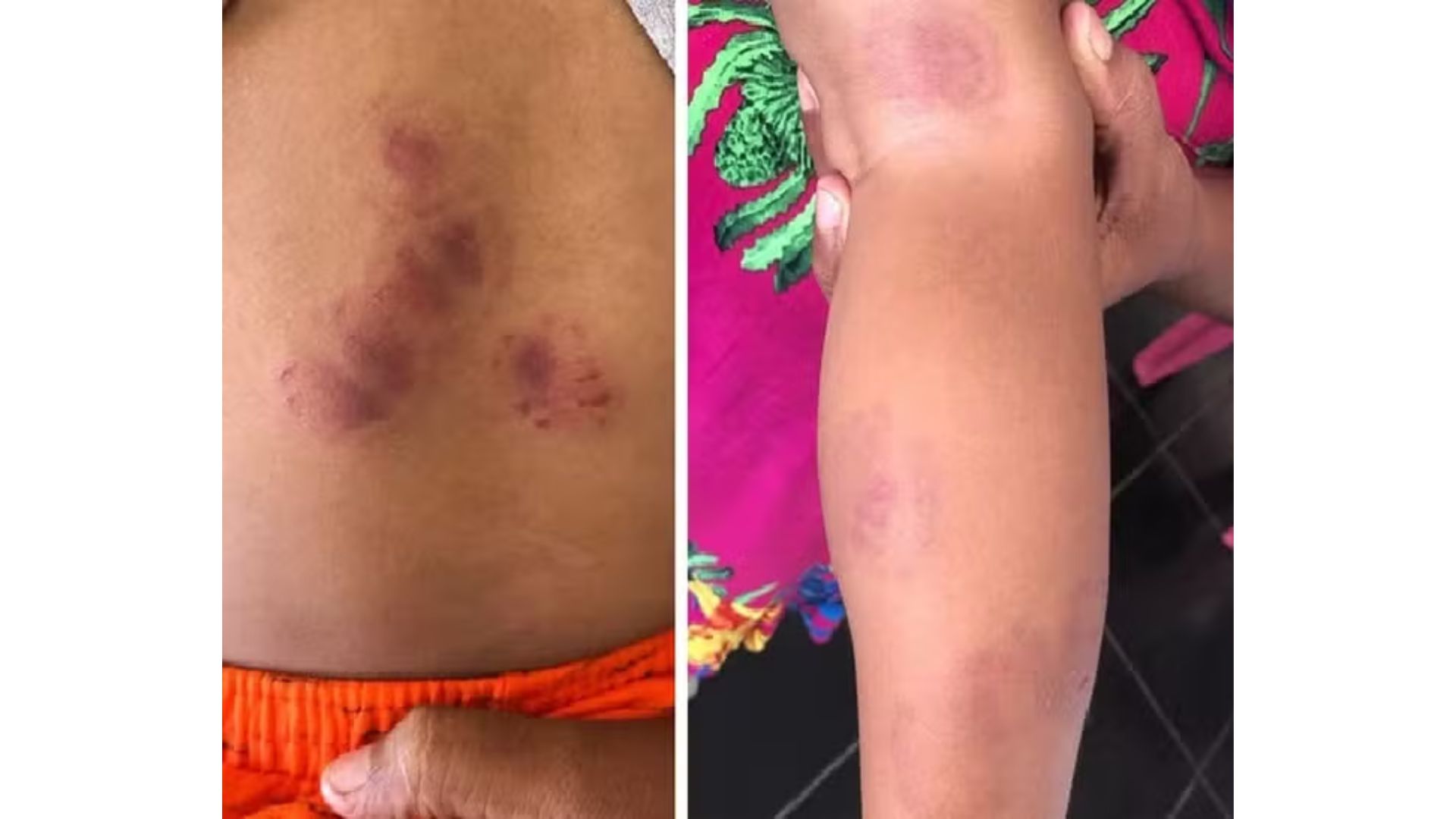 O menino foi mordido 19 vezes