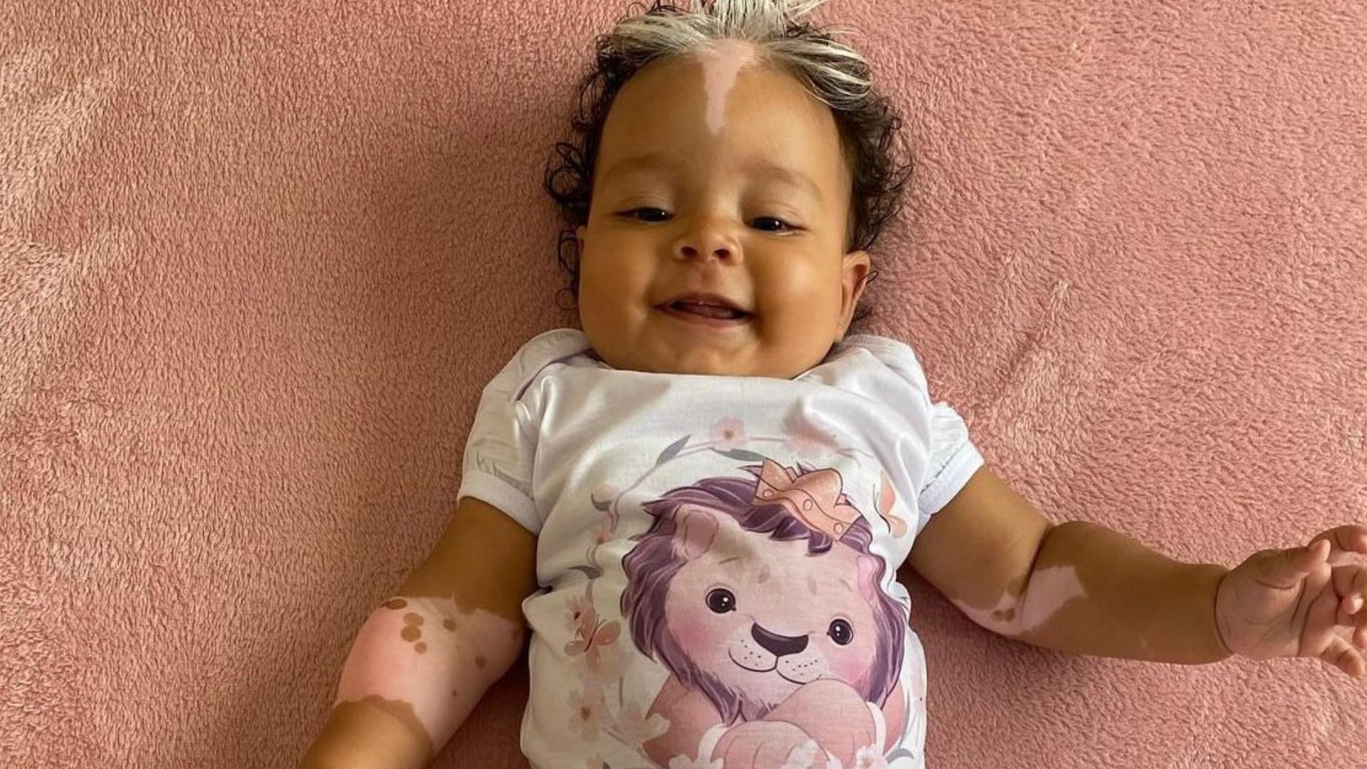 Beb&ecirc; com condi&ccedil;&atilde;o rara