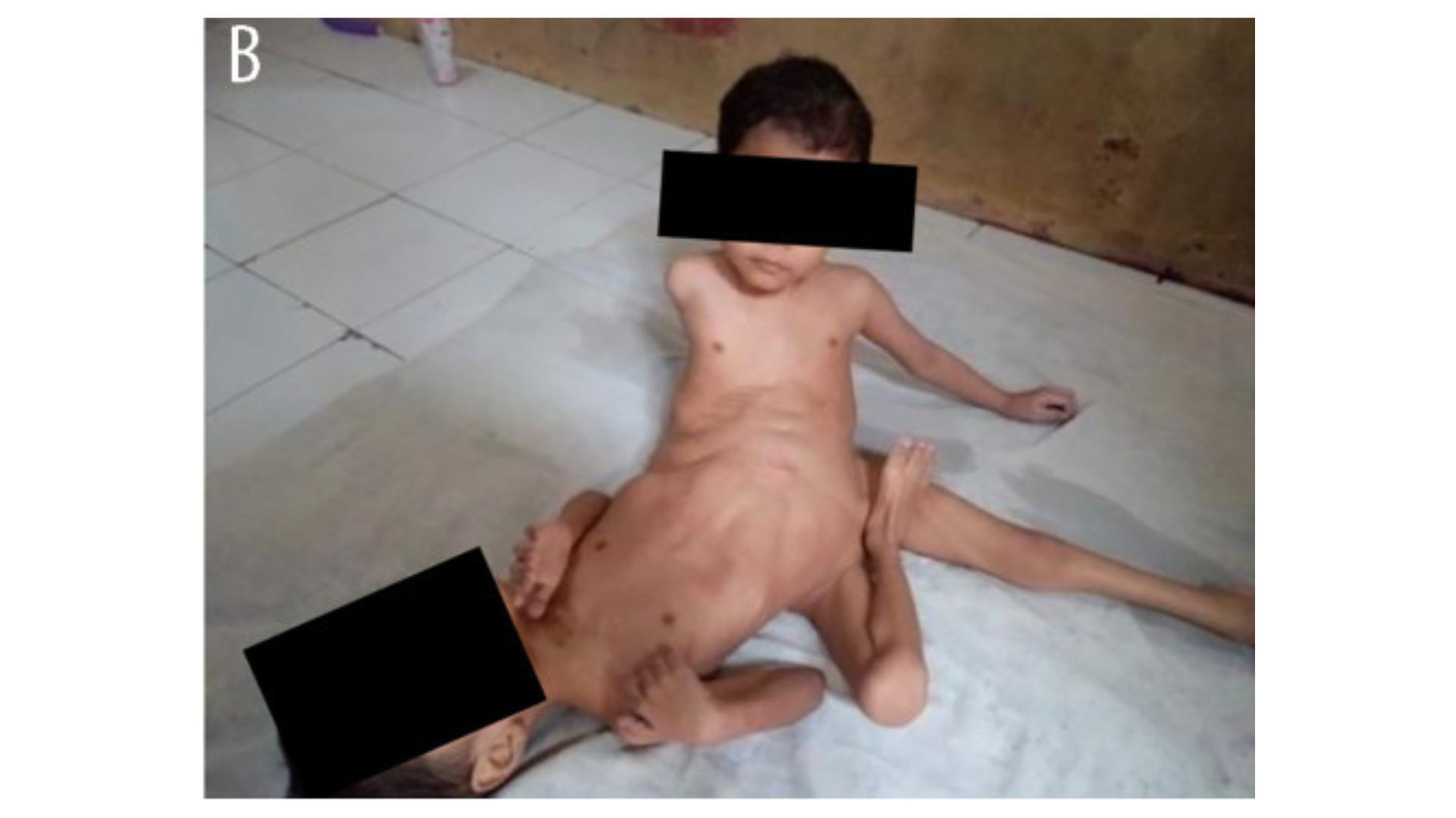 g&ecirc;meos siameses