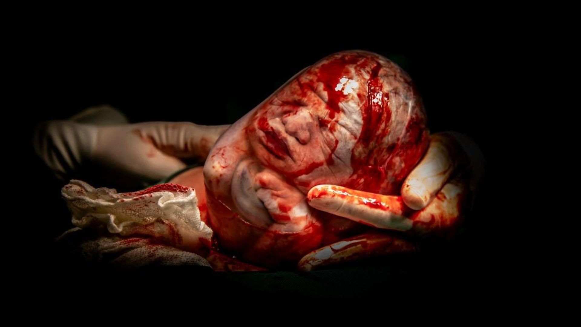 Beb&ecirc; nascendo empelicado